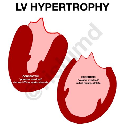 eccentric vs concentric lv hypertrophy.